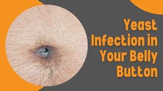 can a belly button infection kill you|Belly Button Yeast Infection: Symptoms, Causes & Treatment